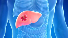 Hasta el 60% de los casos de cáncer de hígado son evitables: descubra cómo