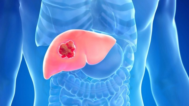 Hasta el 60% de los casos de cáncer de hígado son evitables: descubra cómo
