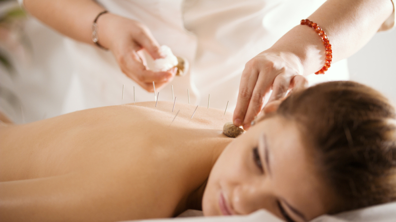 Mujer recibe una sesión de acupuntura. Foto: Shutterstock. 