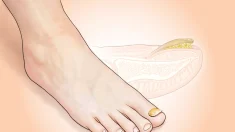 Hongos en las uñas de los pies: una infección persistente que afecta a 1 de cada 10 personas y señales a las que debe prestar atención